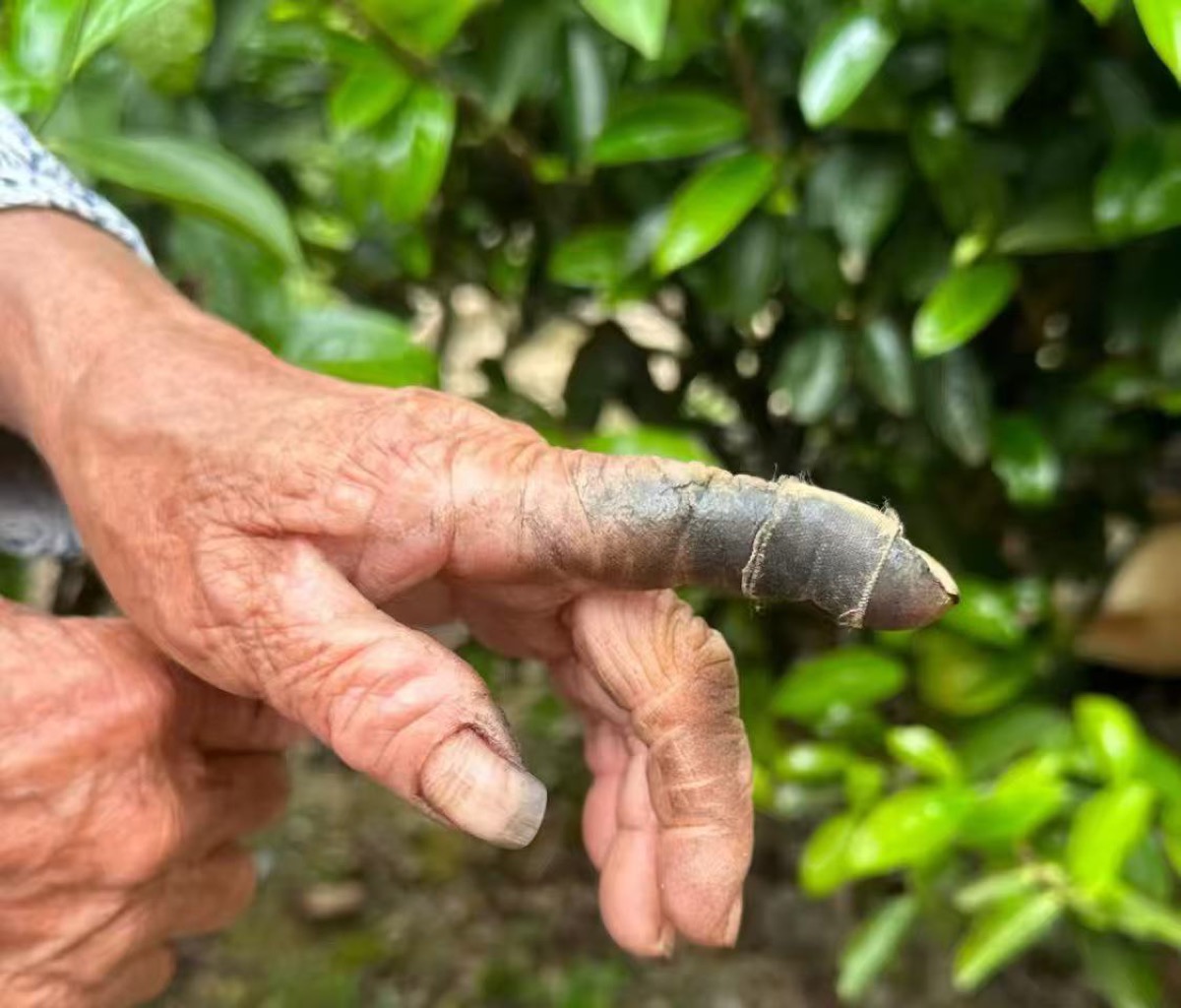An older picker's index finger wrapped in cloth tape, blackened by tea